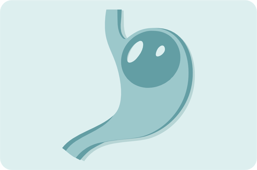 Установка внутрижелудочного баллона