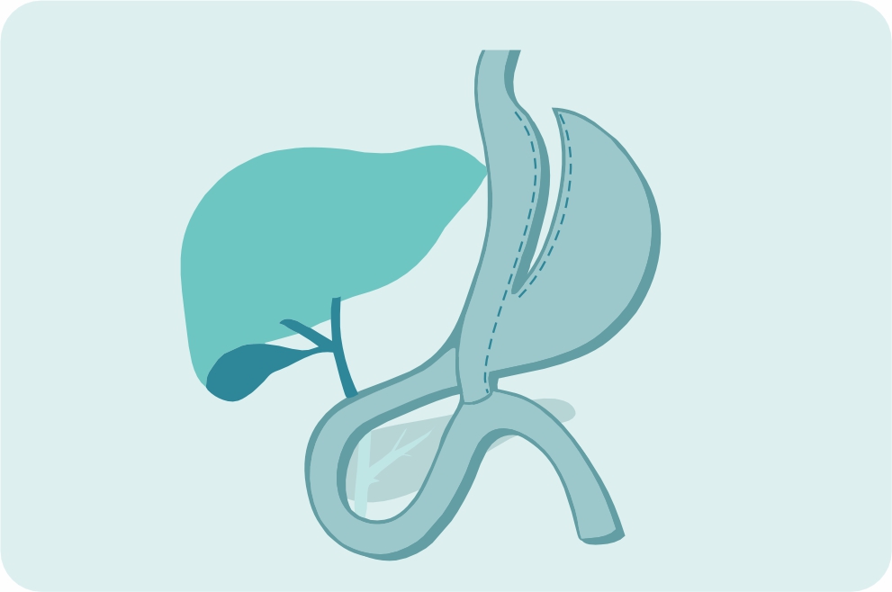 Минигастрошунтированиеа