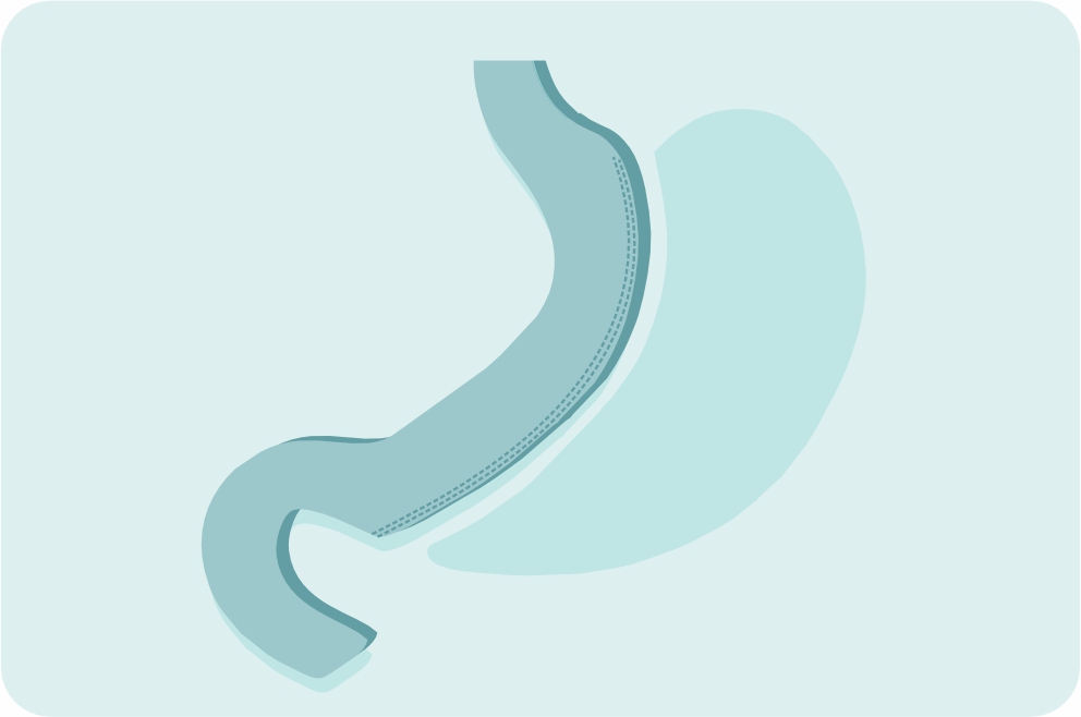 Лапароскопическая продольная резекция желудка