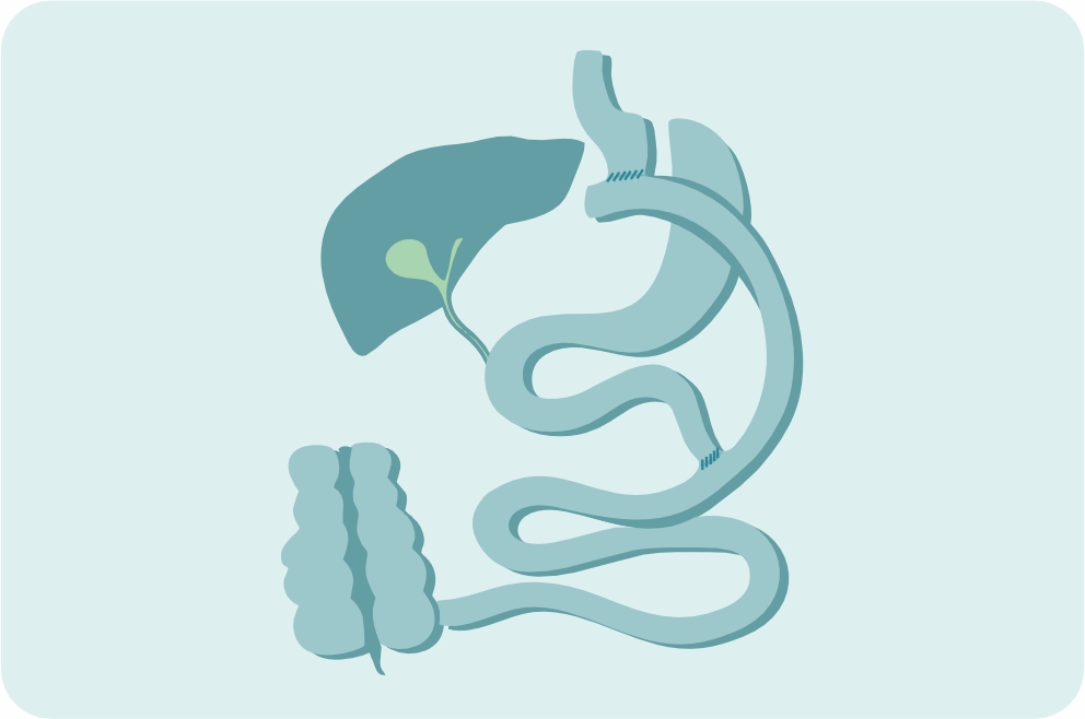 Лапароскопическое гастрошунтирование по Ру