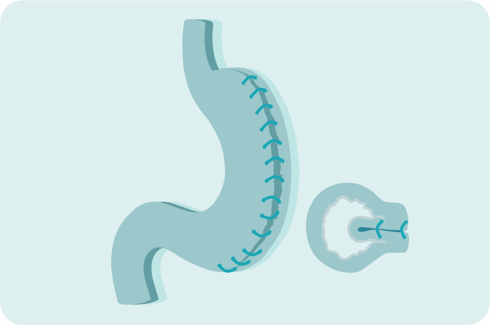 Лапароскопическая гастропликация