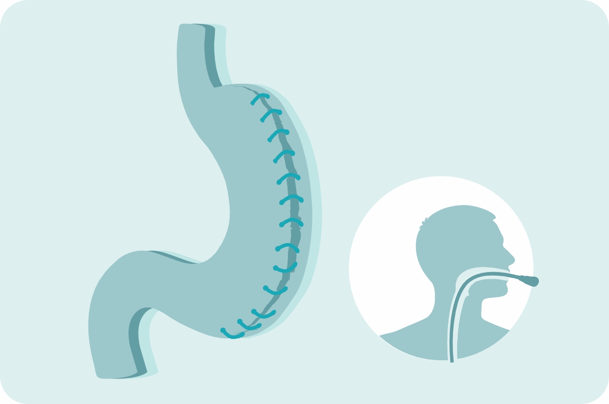 Эндоскопическая гастропластика
